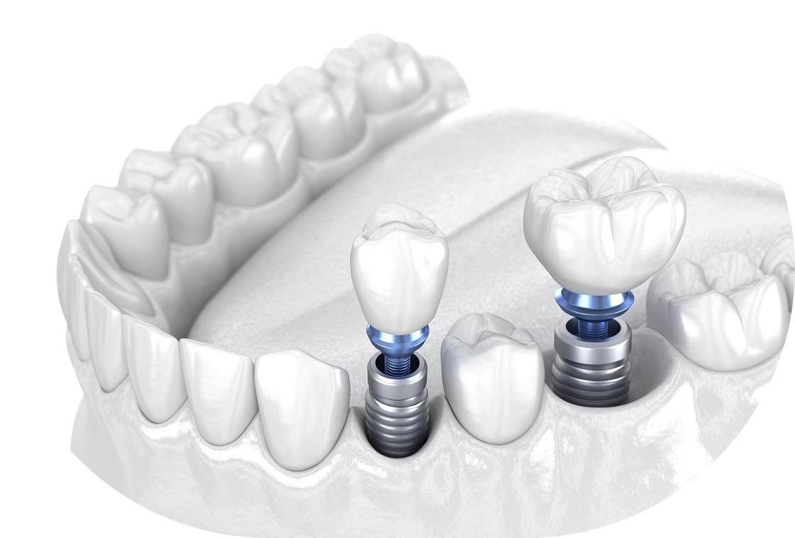 임플란트